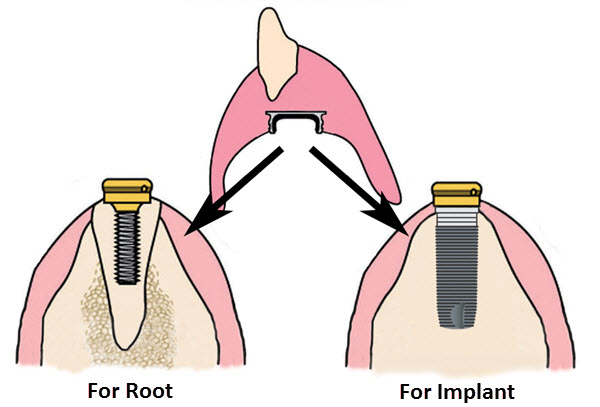 kerator root overdenture system