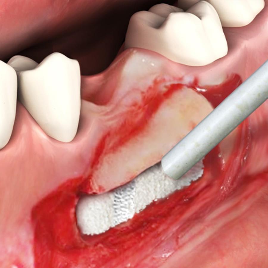 MP3 Bone Mix | Dental & Chiropody Products