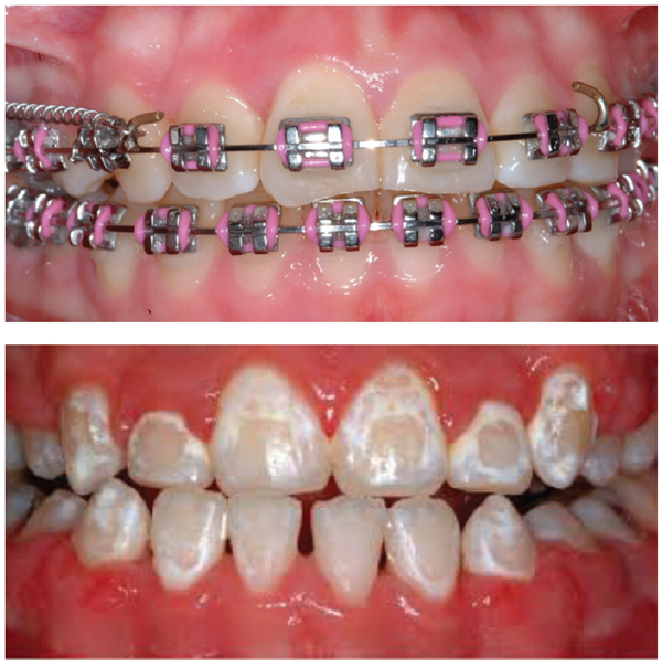 Preventing orthodontic white spot lesions