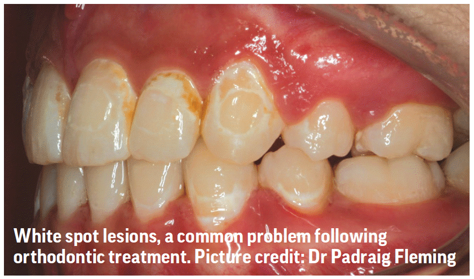 Biomin prevents white spot lesions