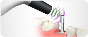 Implant Monitoring