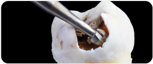 Endodontic Burs