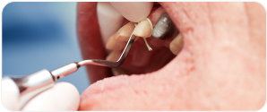 Gingival Retraction