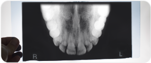 Occlusal Film